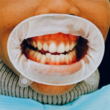 Formation orthophonie - La déglutition