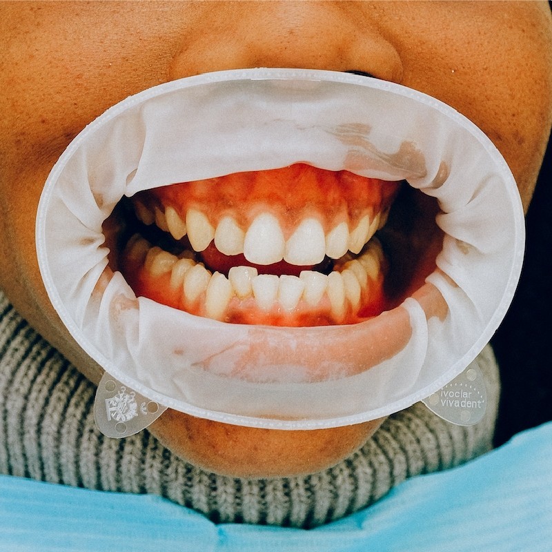 Formation orthophonie - La déglutition